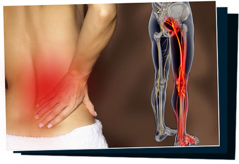 sciatica sos system